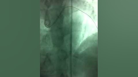 Complication of lad cto pci: cardiac tamponade