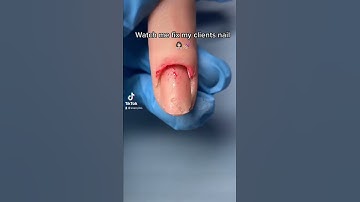 Thumbnail of WATCH ME FIX MY CLIENTS NAIL🤢💅🏼(OMG)😳