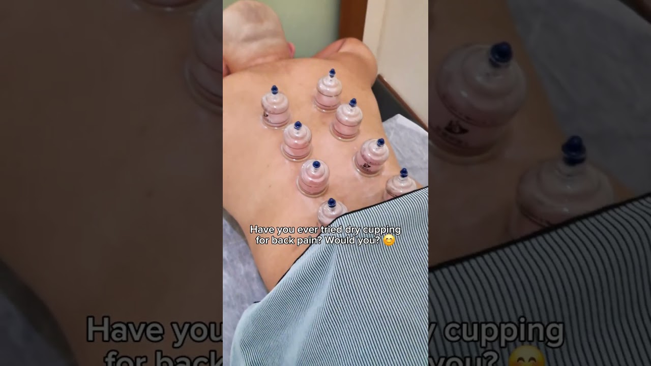 Back Tightness & Pain? Try Dry Cupping Therapy