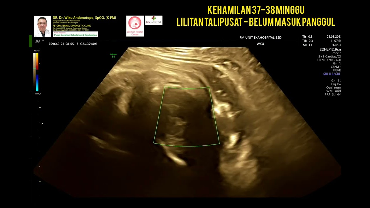 Lilitan talipusat 37-38 minggu