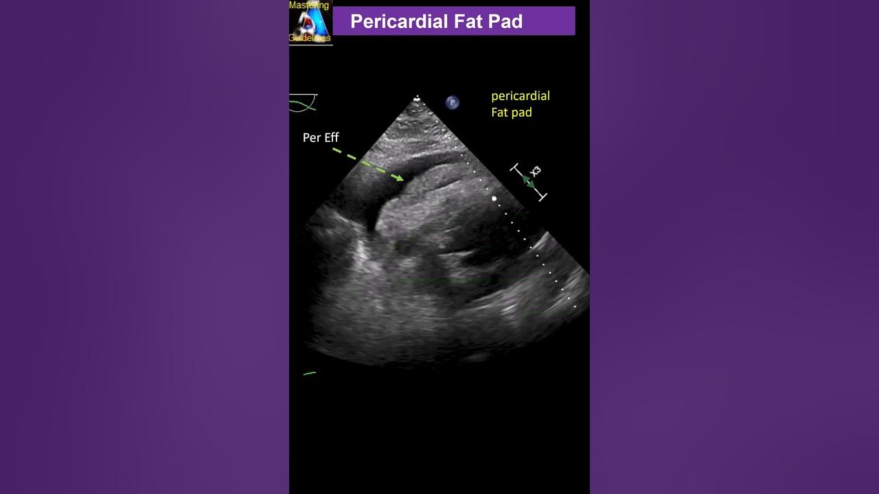pericardial-fat-pad-youtube