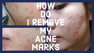 How I manage to Remove my Acne Marks | SKIN CARE | PHILIPPINES