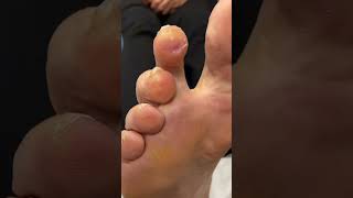 See How This Aussie Podiatrist Tackles A 2Nd Toe Corn/Callus Apex. Prepare To Be Amazed! #Footcaredo