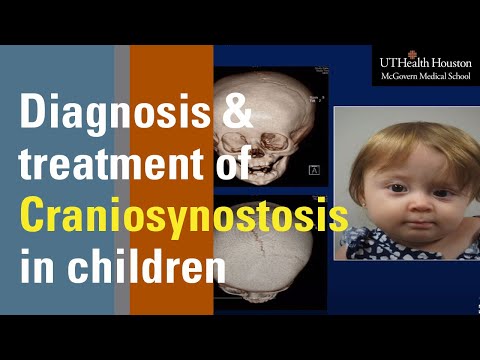 Video: Craniosynostosis: Symptomen, Typen En Chirurgische Opties