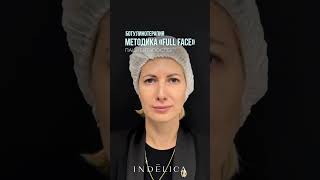 💉 Ботокс Full Face — комплексное омоложение без потери мимики