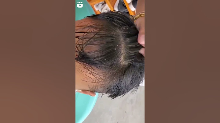 😱😱خطيير انظر ماذا فعل القمل لشعر هذه الفتاة 😱😱😱