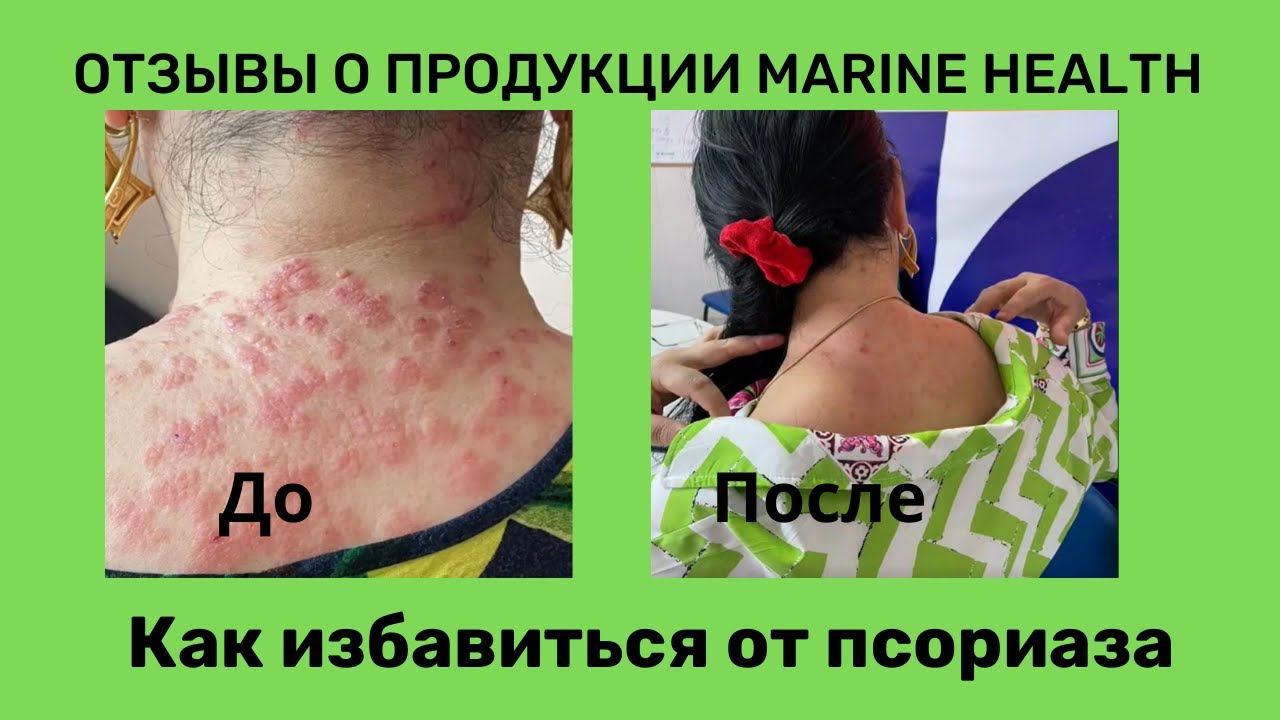 Как избавиться от псориаза навсегда #marinehealth #псориаз #сыпь - YouTube