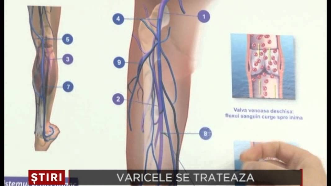 Varicoza pe picioare cauzează simptome - Site despre vene varicoase