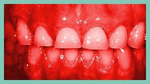 Spear Seminar   Treating the Worn Dentition