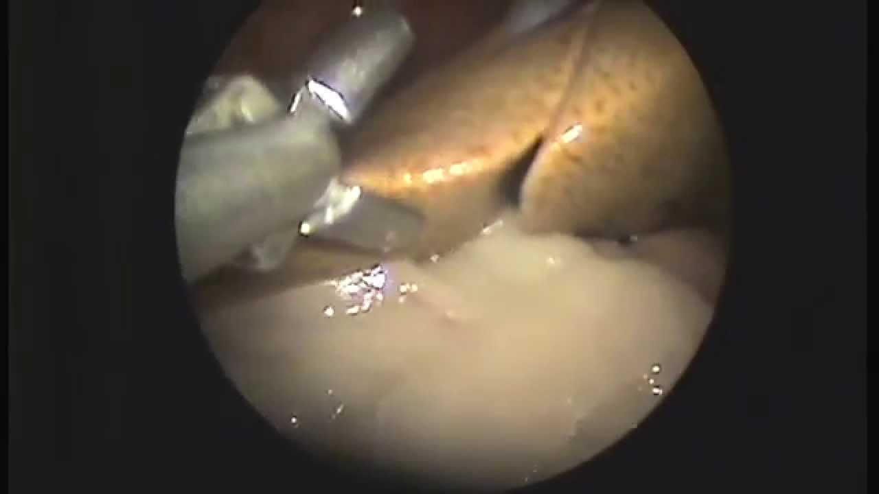 биопсия печени