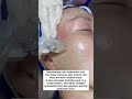 Mesotherapy with hyaluronic acid #shorts