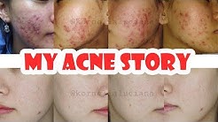 My Acne Story | Perjuangan Melawan Jerawat | Skincare Untuk Kulit Berjerawat | Revisi - Durasi: 15.34. 