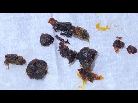 918 - Unbelievable Ear Wax Removal from Child’s Ear