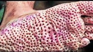 trypophobia  challenge ———— اتحداك تكمل الفديو للاخر 99.9% فشلو في هذا التحدي🤮🤮🤮