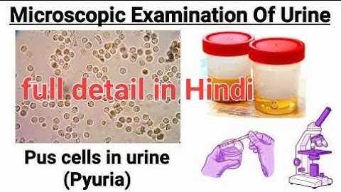urine infection pus ces(pyuria)#dmlt #pathology #laboratory #bmlt #doctor #urine_infection