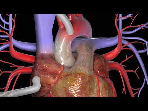 Video: Waarom word koronêre angiografie gebruik?