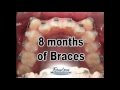 8 Months of Braces - Awesome Smile !