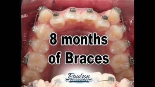 8 Months of Braces - Awesome Smile !