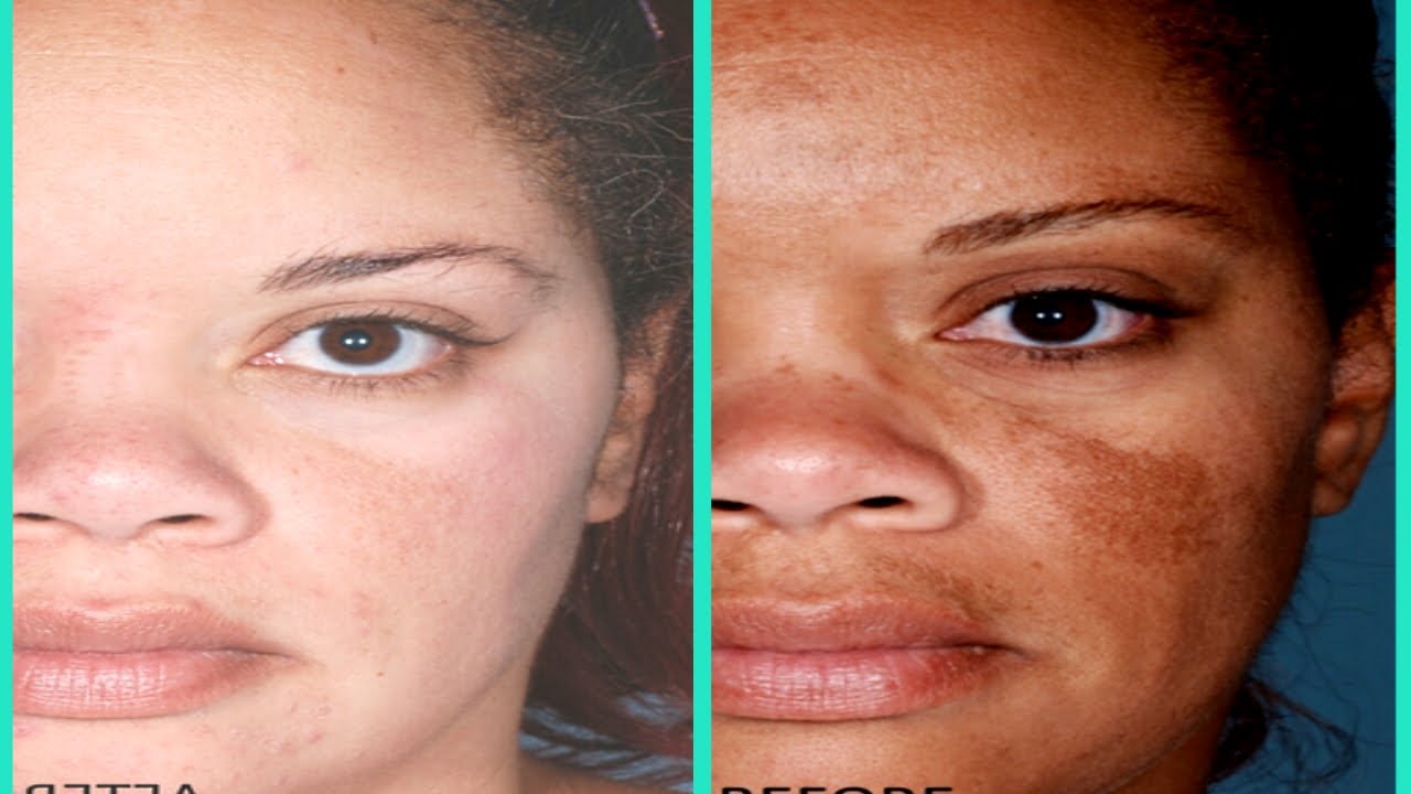 How To Remove Dark Spots Brown Spots Hyperpigmentation Blemishes