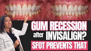 Did you have INVISALIGN and now have GUM RECESSION? SFOT prevents that from happening! You Can Prevent Gum Recession With Invisalign
