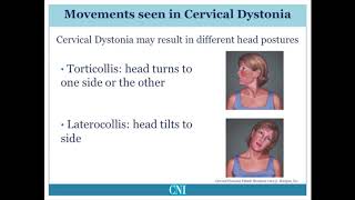 What is Cervical Dystonia?