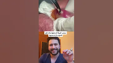 يرقة الجلد من الذبابة تأملو عظمة الخالق 