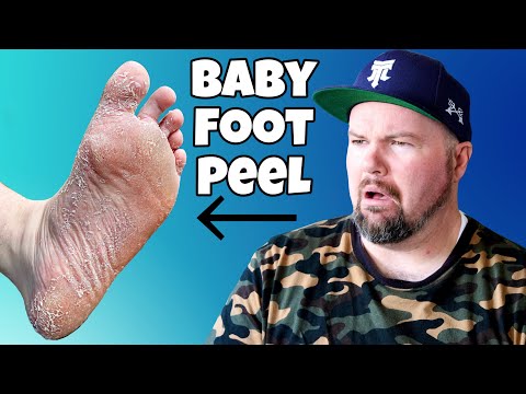 Shaylee Lost A Toe Baby Feet Foot Peel Vlog 106 