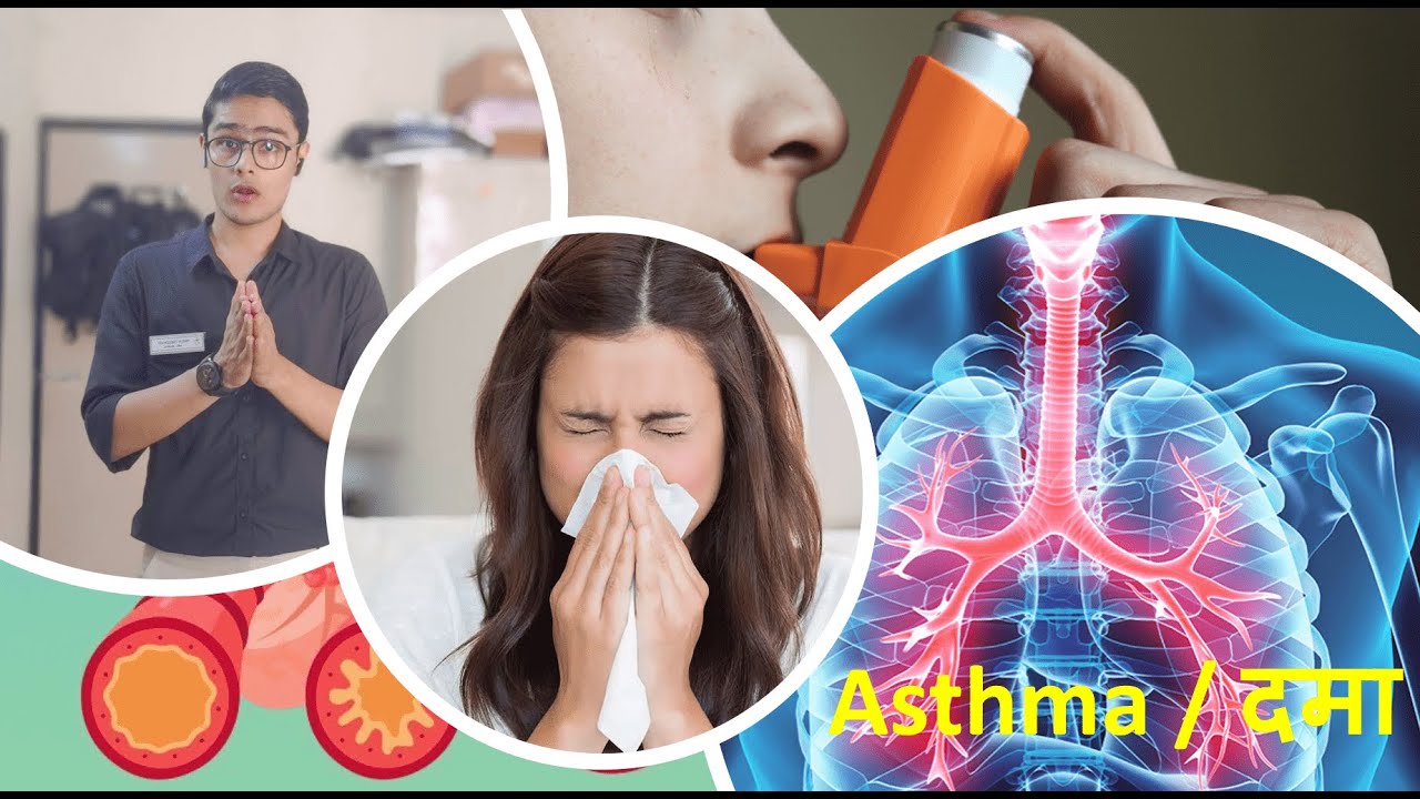 (HINDI)Asthma/दमा/Asthma attack/Bronchial asthmaCause,Symptom