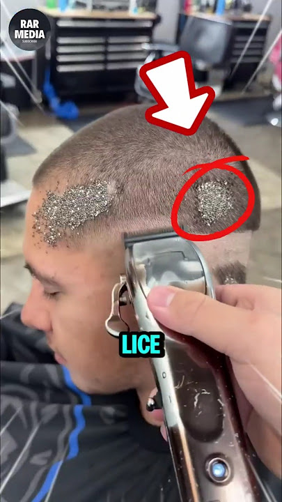 This Man has a Lot of Lice Eggs😱⁉️ #shorts #shortvideo #barber #asmrsounds