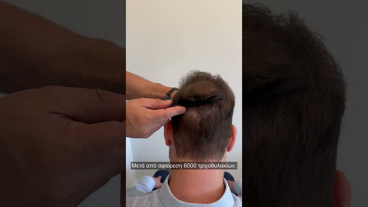 🔥 Μεταμόσχευση Μαλλιών FUE: 6000 τθ & το εντυπωσιακό αποτέλεσμα 3 χρόνια μετά! 💇‍♂️✨ case 
