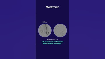 Left ovarian vein embolization