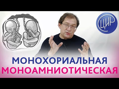 Монохориальная моноамниотическая двойня. Как получаются сиамские близнецы. Гузов И.И.