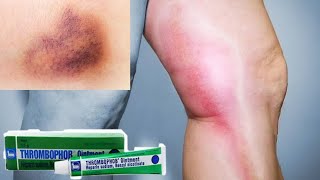 Thrombophob ointment (Heparin Sodium) to treat bruises and phlebitis #bruises #phlebitis