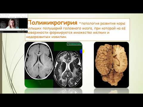 АНОМАЛИИ РАЗВИТИЯ ГОЛОВНОГО МОЗГА У ДЕТЕЙ. КЛИНИЧЕСКИЙ СЛУЧАЙ ГЕМИМЕГАЛЭНЦЕФАЛИИ