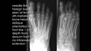 CASE 996 needle foreign body in foot