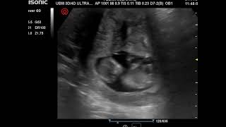 Very Active Baby 11 Weeks Ultrasound