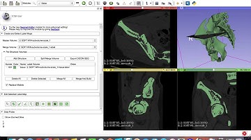 Using 3D slicer to create STL file of a fractured pelvis: Learn 3D Slicer in easy steps