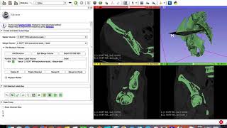 Using 3D slicer to create STL file of a fractured pelvis: Learn 3D Slicer in easy steps screenshot 3