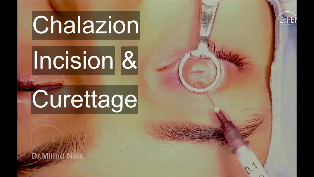 homályos látás a chalazion miatt