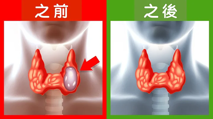 缩小甲状腺结节自然疗法,柏格医生 Dr Berg - 天天要闻