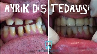 Ayrık Diş Birleştirme Diş Kaplama Si̇zi̇ Çok Şaşirtacak Mi̇ne Denti̇n