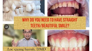 Why Braces Why Braces and Beautiful Smile Can Change Your Life