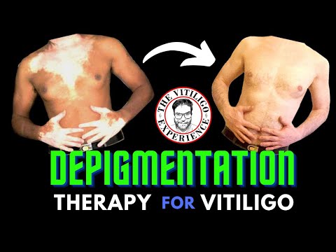 Depigmentazione: un trattamento per la vitiligine che finalmente funziona (episodio 1-2020)