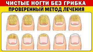 Быстрое Лечение Грибка Ногтей Натуральными Средствами
