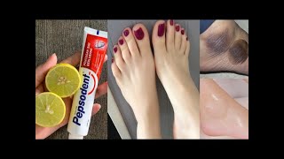 घुटने कोहनी एड़ियों पर सालों से जमी मैल गंदगी बदबू मिंनटो में साफ कर गोरा बना देगा ये नुस्का। Skin