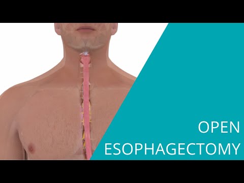 Open Esophagectomy