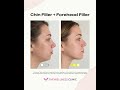 Balancing the Profile: The Structural Power of Forehead & Chin Contour 📐✨