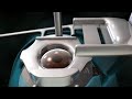 Cirugía ocular LASIK
