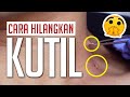 Cara Cepat Hilangkan Kutil, Electro Cauter dengan Dokter Spesialis Kulit - Dokter Kardiana Dewi !!