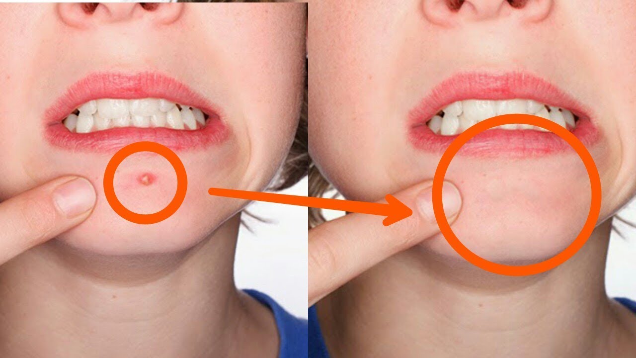 Picsart Editing Tutrial Face spot Remove Tutrial